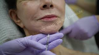 Dimpled Chin | Sue Ellen Cox, MD, FAAD