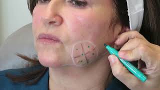 Kybella Jowls Injection | José Raúl Montes MD, FACS, FACCS