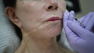 Lip Flip | Sue Ellen Cox, MD, FAAD