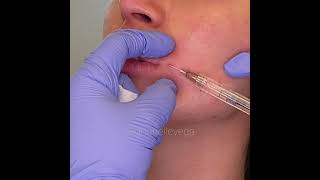 Lip Projection with Cannula | Janelle Vega, M.D., F.A.A.D