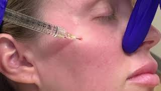 Midface Cannula Technique | Dr. Christopher C. Surek D.O.