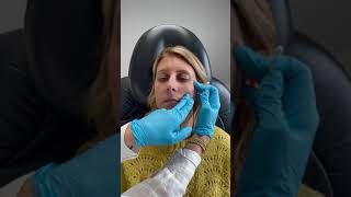 Nasolabial Fold | Flora Levin MD, FACS