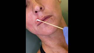 Perioral Lines | Janelle Vega, M.D., F.A.A.D