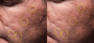 Treatment of Acne Scars