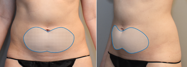 Figure 1. DCA injections to the abdomen.