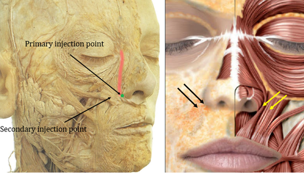 Figure 10: Primary injection point targeting the LLSAN muscle (highlighted in red) at the pyriform aperture (green dot). A secondary injection point can be considered 2mm inferolateral to the primary injection point in select circumstances. Figures reproduced courtesy of André Braz, Atlas de Anatomia e Preenchimento Global da Face.