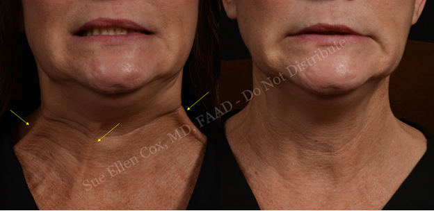 Figure 15: Before (left) and after (right) chemodenervation of platysmal bands. Yellow arrows highlight treated areas of the platysma. Note significant improvement in banding as well as jowling.