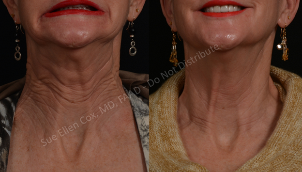 Figure 16: Before (left) and after (right) chemodenervation of platysma. Note improvement in horizontal neck lines, vertical and oblique creasing at the corners of the face, and posterior platysmal banding.