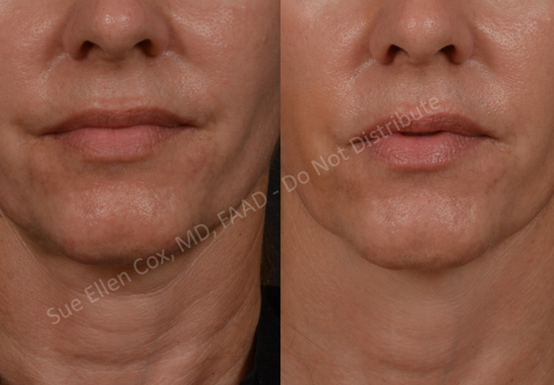 Figure 17: Before (left) and after (right) chemodenervation of platysma. The result is a more defined jaw line, less vertical creasing at the inferolateral face, and fewer horizontal neck lines.