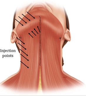 Figure 18: Injection sites to consider for complete treatment of the platysma. The inferior 5 injection points are injected into the platysmal band, while the superior 8 injection sites are located 1cm from the mandible. Note injection along the top row not as common.