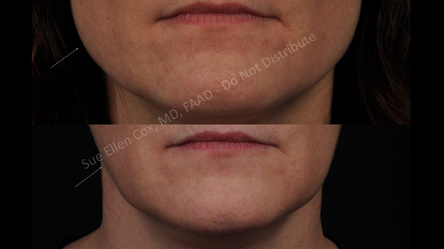 Figure 20: Optimal result from chemodenervation of the masseter - before (above) and after (below). White arrow highlights location of the masseter.