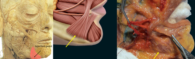 DAO injection point. Injections should be just posterior to the visible marionette line into the palpable, lower portion of the DAO. Avoid the DLI anteriorly, the modiolus superiorly. The mandibular ligament is a posteriorly located landmark. Figures reproduced courtesy of André Braz, Atlas de Anatomia e Preenchimento Global da Face.