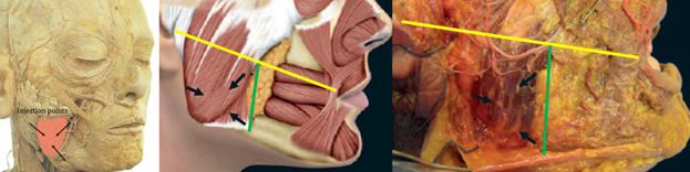 Figure 21: Injection sites for the masseter (black arrows). All injections should be below an imaginary line drawn from the oral commissure to the tragus (yellow) and 1cm posterior to the anterior border of the masseter. Injections must be deep. Figures reproduced courtesy of André Braz, Atlas de Anatomia e Preenchimento Global da Face.