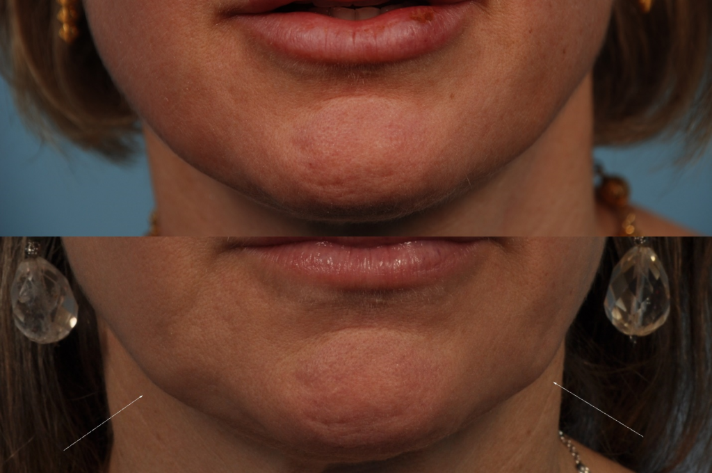 Figure 22: Before (above) and after (below) masseter injection. Chemodenervation of the masseter and consequent atrophy resulted in unsatisfying laxity along the jawline.