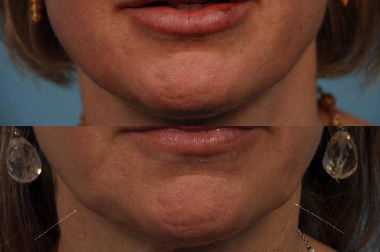 Clinical Application of Neuromodulators Lower Face/Neck Rejuvenation