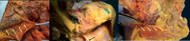 Figure 19: The platysma is a broad, superifical muscle that extends from the chest and neck and overlies muscles of the face. Injection sites to superior portion of platysma are placed superficially approximately 1cm above and below the mandible (yellow arrows). The black arrow identifies the posterior platysmal band, which is easily identifiable clinically. Figures reproduced courtesy of André Braz, Atlas de Anatomia e Preenchimento Global da Face.