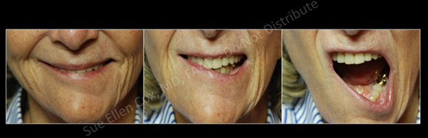 Figure 3: A crooked smile can result from inadvertent unilateral injection of the DLI. In this case, the right DLI has been chemodenervated.