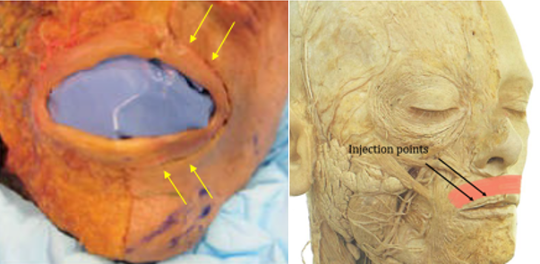 Figure 5: Injection points for orbicularis oris should be symmetrically distributed, avoiding locations too far medially or laterally. Figures reproduced courtesy of André Braz, Atlas de Anatomia e Preenchimento Global da Face.