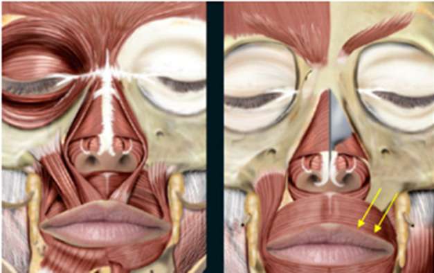 Figure 6: Schematic for injection points of orbicularis oris. Figures reproduced courtesy of André Braz, Atlas de Anatomia e Preenchimento Global da Face.