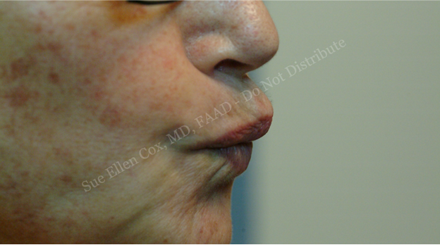 Figure 7: Overcorrection of the orbicularis oris results in lip stiffness and functional difficulties with speech and eating or drinking. Laterally displaced injections can result in central beaking, while centrally displaced injections can flatten the Cupid’s bow.