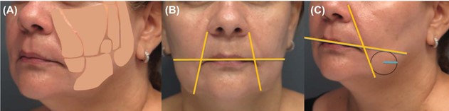 Figure 2: Superficial facial fat compartments (A) and definition of the treatment area (B and C).