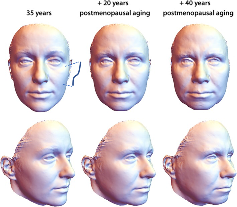 Figure 1. Three-dimensional renderings of progressive facial aging in females. Average facial shape in the most youthful (far left) is 35 years old. Note the ogee curve simulated over the lateral cheek. Over time, there is marked loss of midface volume and squaring of the lower half of the face. Adapted from Am J Phys Anthropol. 2019 Aug; 169(4): 678–6885 with public usage/open domain permissions.