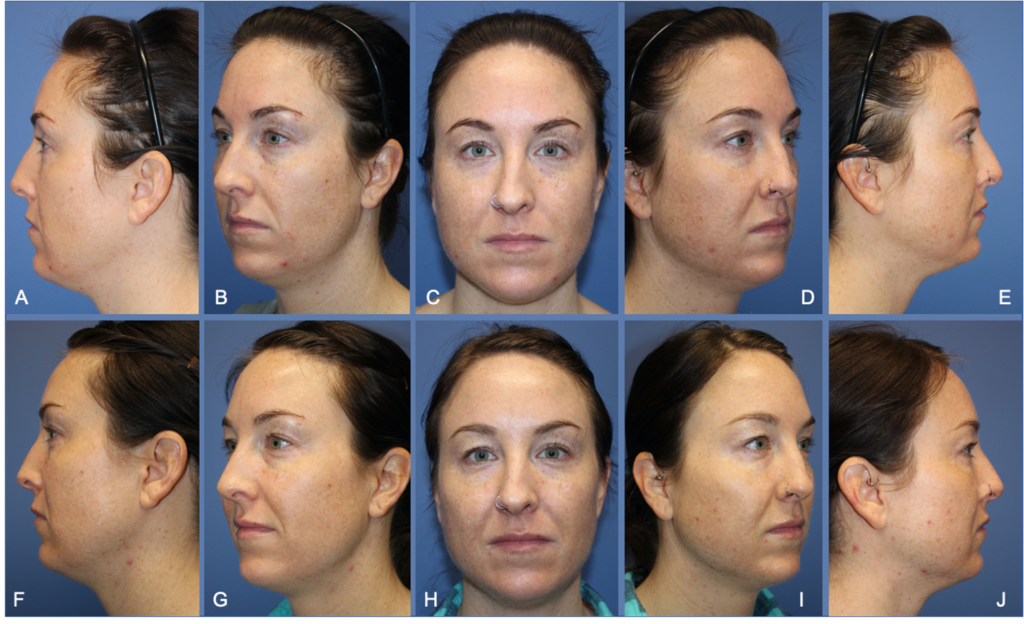 Figure 4. Patient example with hyaluronic acid filler treatment to the midface utilizing the anatomy of the prezygomatic space. Comparing pre-treatment (A-E) to long-term result (F-J) 6 months after injection of 1cc of HA. This product should last 10-12 months.