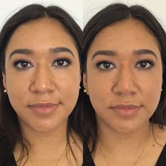 Left: Before Right: Immediately post procedure