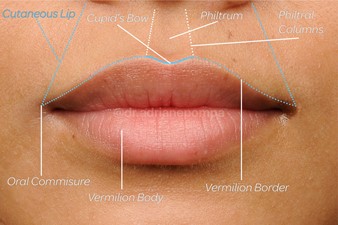 Figure 1: Perioral anatomy. The areas outlined in blue are the borders of the cutaneous lip.