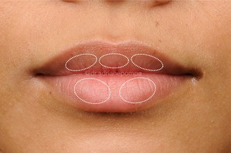 Figure 2: The aesthetic subunits of the lips: Tubercles.