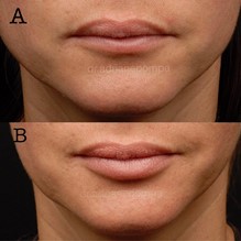 Figure 4 (A,B): Lip augmentation in a Hispanic patient, where the upper to lower lip ratio approaches 1:1 and is preferable for this patient’s lip and facial proportions. Photos courtesy of Dr. Adriane Pompa