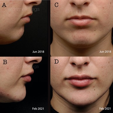 Figure 5 (A,B,C,D): Lip and chin augmentation in a Hispanic patient. In contrast to the patient in the previous figure, her features are more consistent with the classic Cauciasian metrics, and her upper to lower lip ratio approaches a 1:1.618 ratio. Photos courtesy of Dr. Janelle Vega