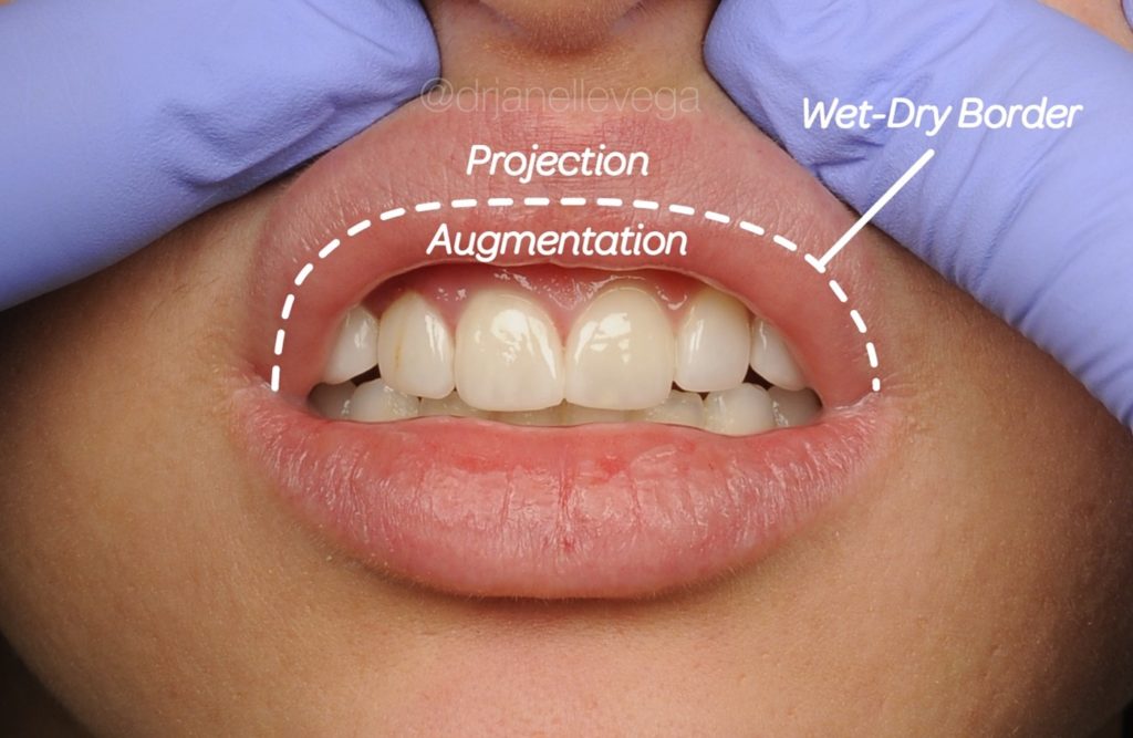 Figure 6: Eversion of the dry red lip will allow visualization of the wet-dry border. For the upper lip, injection in the area superior to the wet-dry border (in the dry red lip and vermilion border) will result in more projection of the lip. Injection in the area inferior to the wet-dry border will result in augmentation of the lip size. This applies to both needle and cannula injection techniques.