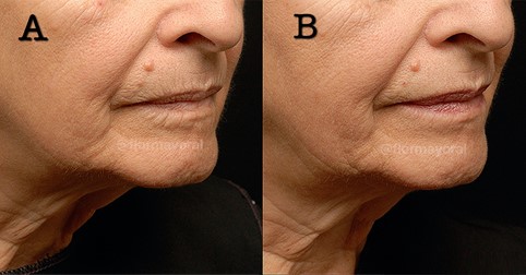 Figure 7: Before and after serial puncture technique for perioral rhytids. Photos courtesy of Dr. Flor Mayoral