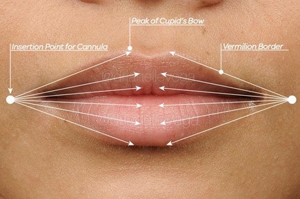 Figure 8: Entry ports for cannula and target locations are shown. The insertion point should be 1 - 2 mm lateral to the oral commissures on either side of the lip. First, direct the cannula inside the vermilion border within one of the lip quadrants with the goal of reaching the peak of the Cupid’s bow. Then, inject the product in a retrograde linear threading fashion. The next threads of filler can be placed within the vermilion body, wet-dry border or the red lip, depending on the patient's needs as determined by the injector’s assessment. The process can now be completed within each of the four lip quadrants, accessing them from the two entry points on either side of the lip. 