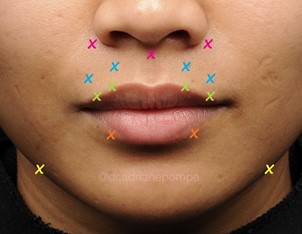 Fig 11: Neuromodulator placement for perioral rejuvenation. Pink: Gummy smile. Blue +/- Orange: Perioral Rhytides. Green +/- Orange: Lip Flip. Yellow: Depressor Anguli Oris.