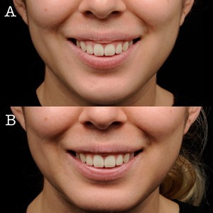 Figure 12: Gummy smile correction: treated LLSAN and orbicularis oris in area designated for “lip flip.” Photos courtesy of Dr. Janelle Vega