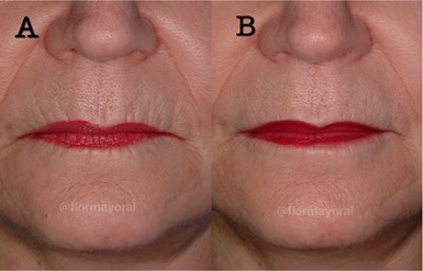 Figure 13: Treatment of perioral rhytids with a combination of neuromodulators and hyaluronic acid using the serial puncture technique. Photos courtesy of Dr. Flor Mayoral