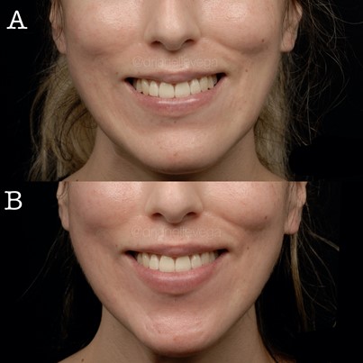 Figure 14 A,B: Injection of Depressor Anguli Oris causing less downward pull on the corners of the mouth when smiling. Photos courtesy of Dr. Janelle Vega