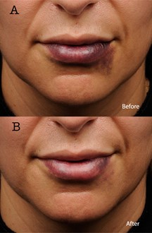 Figure 15 A,B: Pulsed-dye laser (PDL) for bruising. The patient was treated using a 595-nm PDL (Vbeam Perfecta, Syneron Candela INC., California, USA) 72 hours after filler injection and ecchymosis progression. Figure 15A shows the patient at baseline after bruising from lip augmentation 48 hours prior, and Figure 15B shows improvement of the bruise 24 hours after treatment with PDL. Treatment was performed on the cutaneous lip with a spot size of 10mm, fluence of 6.0 J/cm2, and a pulse duration of 6 ms. On the vermilion lip, treatment was performed with a spot size of 10mm, fluence of 6.0 J/cm2, and a pulse duration of 10 ms. Photos courtesy of Dr. Janelle Vega