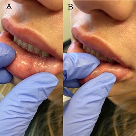 Figure 16 (A,B): This figure shows an example of a filler nodule from superficial placement of hyaluronic acid that is benign in nature. This is easily corrected using the methods discussed of extraction after wound incision or the use of hyaluronidase to dissolve the visible nodule. For more precise results, hold the excess filler between the fingertips as shown in Figure 16B to ensure that only excess product is dissolved or removed, and not the product you would like to avoid dissolving. Photos courtesy of Dr. Janelle Vega