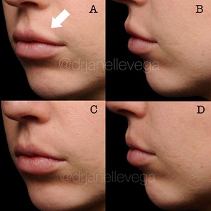 Figure 17 (A,B,C,D): The patient shown previously had a lip augmentation at another clinic and was unhappy with the excess fullness of the cutaneous upper lip (Figure 17 A,B). This result can be caused by technique and/or product choice. The patient is shown (Figure 17 C,D) one week post-treatment with hyaluronidase in the upper cutaneous lip to restore her natural lip contour. The half-life of hyaluronidase is short at just two minutes, but the duration of action is seen up to 48 hours post injection.[108] Therefore it is the recommendation of the authors that injectors wait between 3 - 7 days before reinjection of hyaluronic acid to avoid unwanted dissolution of fillers. Photos courtesy of Dr. Janelle Vega