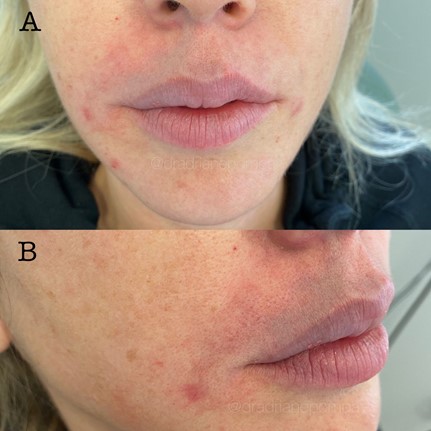 Figure 18 (A,B): Early stage arterial occlusion from fillers