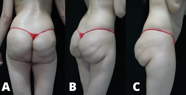 Non-surgical Buttock Augmentation - Rejuvenation Resource