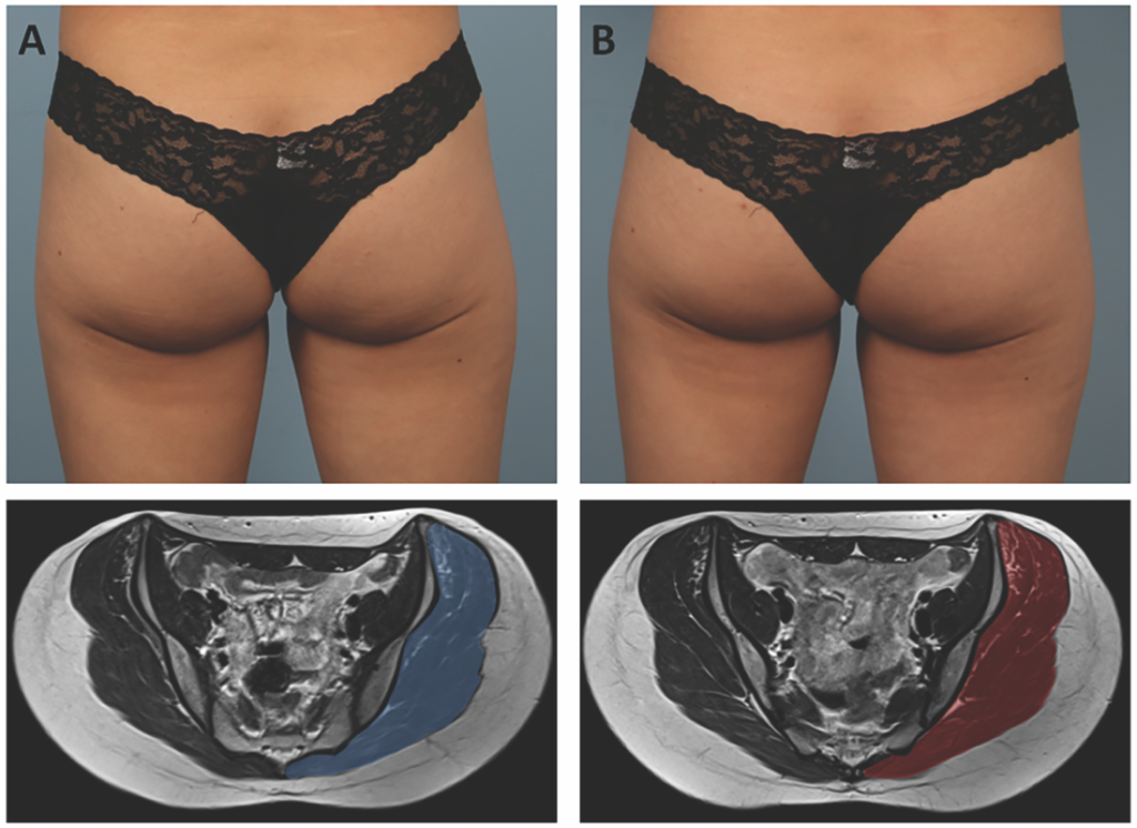 Figure 9:  HIFEM Treatment of Gluteus Muscles. Baseline (A) and 3-month follow-up (B) MRI of HIFEM-treated patient. No structural changes in fat deposits were observed. The thickness of the subcutaneous layer was not significantly affected by the treatments. The enlargement of gluteal muscles at the 3-month follow-up is visible. The more profound hypertrophic effect was observed in the upper buttock region.  Photo courtesy of Melanie D. Palm, MD, MBA, Solana Beach, CA.