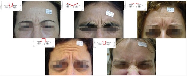 Figure 2. Glabellar Rhytid Assessment (De Almeida injection patterns for glabella: de Almeida AR, da Costa Marques ER, Banegas R, Kadunc BV. Glabellar contraction patterns: a tool to optimize botulinum toxin treatment. Dermatologic surgery. 2012 Sep;38(9):1506-15.)