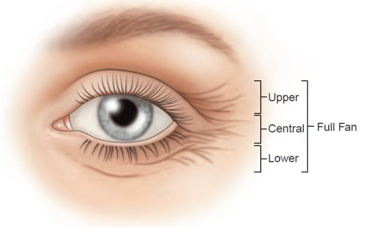 Figure 3. Assessment of Crows Feet (Crow’s feet figure: Bertucci V, Almohideb M, Pon K. Approaches to Facial Wrinkles and Contouring. In: Kantor J, ed. Dermatologic Surgery. New York: McGraw-Hill Education; 2018. P. 1243-70.)