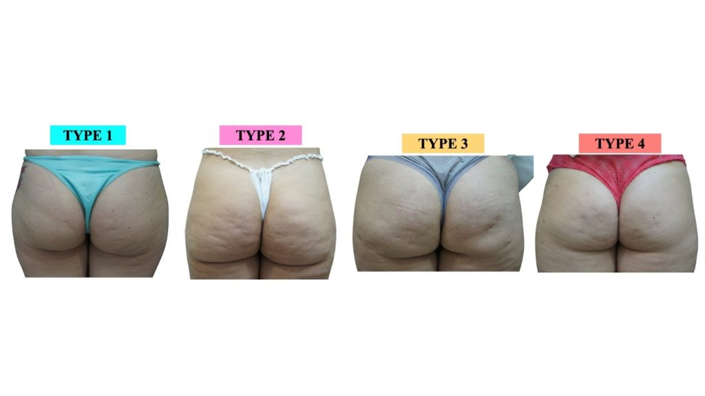 Figure 2 Types of cellulite according to scale grading and also fat accumulation grading 