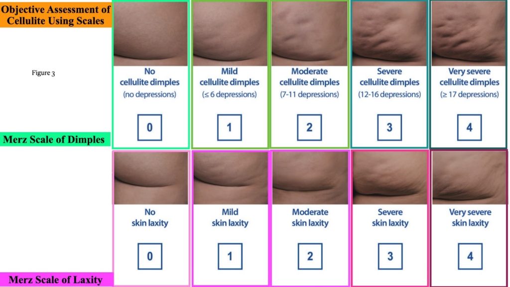 Figure 3 How to use the scales to grade cellulite patients