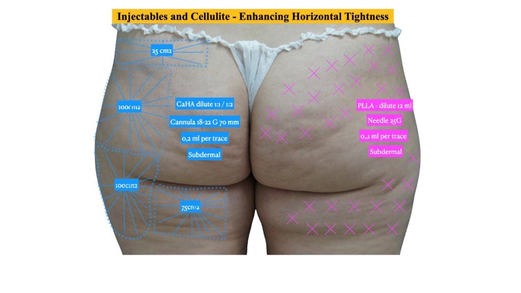 Figure 4 Enhancing Horizontal vector with injectables